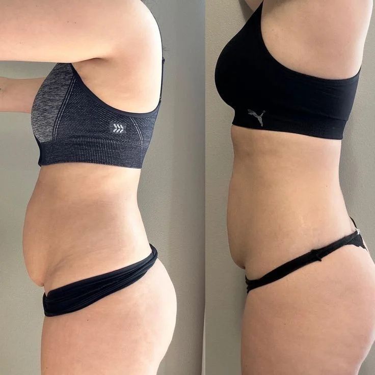 Antes depois do chás